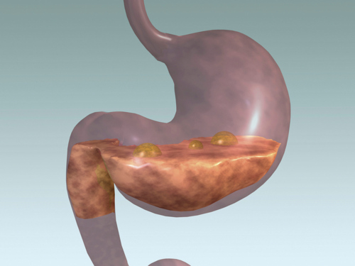                                                                                             Atendemos:
Reflujos
Gastroesofágico 
Prevención de cáncer de colon
Pólipos colónicos
Hepatitis cronica 
Cirrosis
Enfermedades digestivas incluyendo hígado y páncreas.
                                                                                    