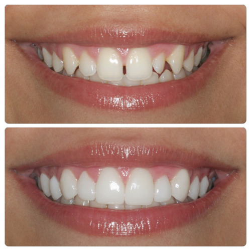                                                                                             Aceptamos todos los planes médicos incluyendo Plan Vital. Atendemos emergencias sin cita previa.
extracciones dentales 
limpieza dental 
restauraciones esteticas
blanqueamiento dental 
puentes
coronas
                                                                                    