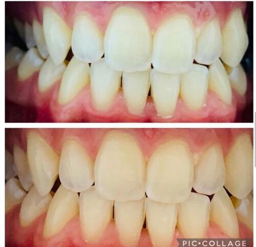 • Coronas
• Puentes
• Dentaduras
• Implantes
• Laminados en porcelana
• Rehabilitación oral y estética
• Blanqueado
• Diseño de Sonrisa
• Botox terapéutico: pacientes con hábitos parafuncionales como clenching y bruxismo. El Botox terapéutico les ayuda a relajar los músculos y aliviar el dolor.
• Bótox: para reducir líneas de expresión y lucir más joven.