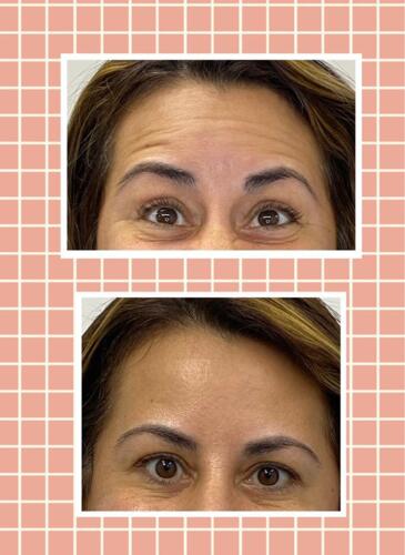 • Coronas
• Puentes
• Dentaduras
• Implantes
• Laminados en porcelana
• Rehabilitación oral y estética
• Blanqueado
• Diseño de Sonrisa
• Botox terapéutico: pacientes con hábitos parafuncionales como clenching y bruxismo. El Botox terapéutico les ayuda a relajar los músculos y aliviar el dolor.
• Bótox: para reducir líneas de expresión y lucir más joven.