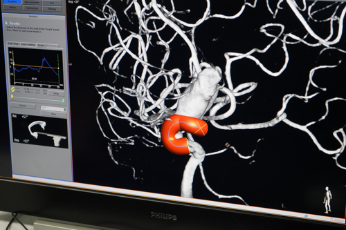 Condiciones tratadas por Neurocirugía Endovascular:
• Embolizaciones Aneurismas Cerebrales en adultos y niños
• Embolizaciones Malformaciones Vasculares Cerebrales y de Espina en adultos y niños
• Embolizaciones de Tumores Cerebrales y Espina preoperatorio
• Embolizaciones Fístulas Arteriovenosas en adultos y niños
• Tratamiento agudo de Derrames Cerebrales, Isquémicos y Hemorrágicos
• Estenosis Carotídea - angioplastia y stent
• Embolización de Hemangiomas Cutáneos
• Arteriografía Diagnóstica (DSA) / Terapéutica de cerebro y espina
• Cirujano Neuro-Endovascular