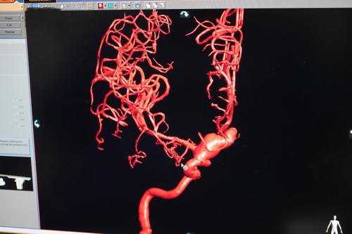 Condiciones tratadas por Neurocirugía Endovascular:
• Embolizaciones Aneurismas Cerebrales en adultos y niños
• Embolizaciones Malformaciones Vasculares Cerebrales y de Espina en adultos y niños
• Embolizaciones de Tumores Cerebrales y Espina preoperatorio
• Embolizaciones Fístulas Arteriovenosas en adultos y niños
• Tratamiento agudo de Derrames Cerebrales, Isquémicos y Hemorrágicos
• Estenosis Carotídea - angioplastia y stent
• Embolización de Hemangiomas Cutáneos
• Arteriografía Diagnóstica (DSA) / Terapéutica de cerebro y espina
• Cirujano Neuro-Endovascular
