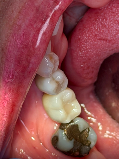 Corozal Dental(2).JPG
Corozal Dental(3).jpg
Corozal Dental(4).JPG
Corozal Dental(5).jpg
Corozal Dental(6).JPG
Corozal Dental(7).JPG
Corozal Dental(8).JPG
Corozal Dental(9).jpg
Corozal Dental(10).JPG
Corozal Dental(11).JPG
Corozal Dental(12).JPG
Corozal Dental(13).JPG
Corozal Dental(14).JPG
Healing cap.jpg
Implante.jpg