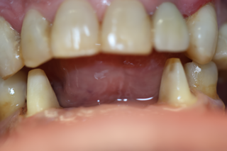 Corozal Dental(2).JPG
Corozal Dental(3).jpg
Corozal Dental(4).JPG
Corozal Dental(5).jpg
Corozal Dental(6).JPG
Corozal Dental(7).JPG
Corozal Dental(8).JPG
Corozal Dental(9).jpg
Corozal Dental(10).JPG
Corozal Dental(11).JPG
Corozal Dental(12).JPG
Corozal Dental(13).JPG
Corozal Dental(14).JPG
Healing cap.jpg
Implante.jpg