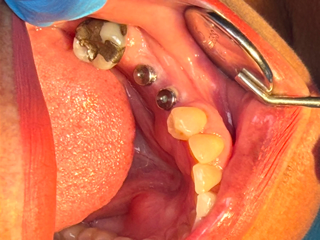 Corozal Dental(2).JPG
Corozal Dental(3).jpg
Corozal Dental(4).JPG
Corozal Dental(5).jpg
Corozal Dental(6).JPG
Corozal Dental(7).JPG
Corozal Dental(8).JPG
Corozal Dental(9).jpg
Corozal Dental(10).JPG
Corozal Dental(11).JPG
Corozal Dental(12).JPG
Corozal Dental(13).JPG
Corozal Dental(14).JPG
Healing cap.jpg
Implante.jpg