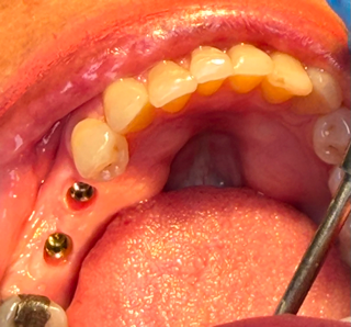 Corozal Dental(2).JPG
Corozal Dental(3).jpg
Corozal Dental(4).JPG
Corozal Dental(5).jpg
Corozal Dental(6).JPG
Corozal Dental(7).JPG
Corozal Dental(8).JPG
Corozal Dental(9).jpg
Corozal Dental(10).JPG
Corozal Dental(11).JPG
Corozal Dental(12).JPG
Corozal Dental(13).JPG
Corozal Dental(14).JPG
Healing cap.jpg
Implante.jpg